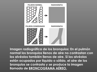 Imagen radiográfica de los bronquios: En el pulmón
normal los bronquios llenos de aire no contrastan con
los alvéolos también llenos de aire. Si los alvéolos
están ocupados por líquido o sólido, el aire de los
bronquios se contrasta y se produce la imagen
llamada de BRONCOGRAMA AÉREO.
 