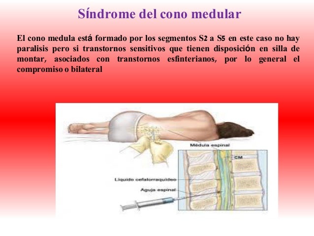 sindrome