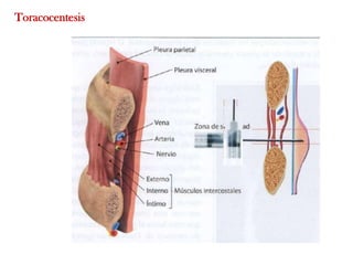 Toracocentesis
 