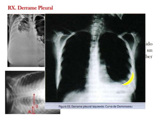 RX. Derrame Pleural

                      Opacificacion

                      Velamiento seno costofrénico

                      Ángulo costofrénico borrado: líquido
                      en la imagen(300-500 ml) cuando es un
                      derrame pleural completo puede haber
                      hasta unos 4 litros.



                      Densidad homogénea con el
                      margen superior cóncavo (Curva
                      damoiseaux).
 