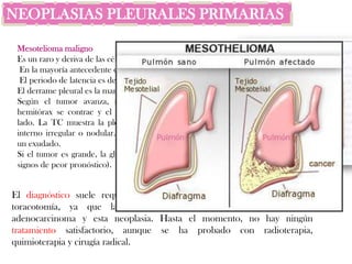NEOPLASIAS PLEURALES PRIMARIAS

 Mesotelioma maligno
 Es un raro y deriva de las células mesoteliales.
  En la mayoría antecedente de exposición al asbesto.
  El periodo de latencia es de 20-40 años.
 El derrame pleural es la manifestación más frecuente.
 Según el tumor avanza, reviste a todo el pulmón, el
 hemitórax se contrae y el mediastino se desvía hacia ese
 lado. La TC muestra la pleura engrosada con un margen
 interno irregular o nodular. El análisis del líquido muestra
 un exudado.
 Si el tumor es grande, la glucosa y el pH disminuyen (son
 signos de peor pronóstico).


El diagnóstico suele requerir toracoscopia, e incluso en muchos casos
toracotomía, ya que la biopsia cerrada no suele discernir entre
adenocarcinoma y esta neoplasia. Hasta el momento, no hay ningún
tratamiento satisfactorio, aunque se ha probado con radioterapia,
quimioterapia y cirugía radical.
 
