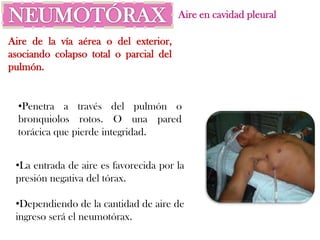 Aire en cavidad pleural

Aire de la vía aérea o del exterior,
asociando colapso total o parcial del
pulmón.


  •Penetra a través del pulmón o
  bronquiolos rotos. O una pared
  torácica que pierde integridad.


 •La entrada de aire es favorecida por la
 presión negativa del tórax.

 •Dependiendo de la cantidad de aire de
 ingreso será el neumotórax.
 