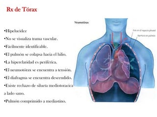 Rx de Tórax


•Hipelucidez
•No se visualiza trama vascular.
•Fácilmente identificable.
•El pulmón se colapsa hacia el hilio.
•La hiperclaridad es periférica.
•El neumotórax se encuentra a tensión.
•El diafragma se encuentra descendido.
•Existe rechazo de silueta mediotoracica
a lado sano.
•Pulmón comprimido a mediastino.
 