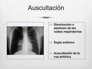 Radiografías
Pulmón colapsado
Aire en la cavidad pleural
 