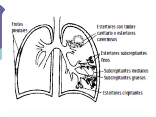 Síndromes pleuropulmonares (Semiología)