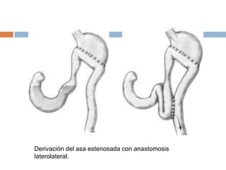 Derivación del asa estenosada con anastomosis
laterolateral.
 