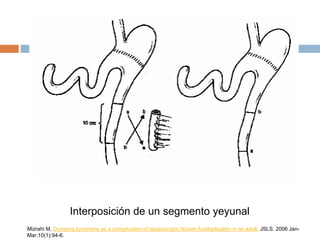 Interposición de un segmento yeyunal
Mizrahi M, Dumping syndrome as a complication of laparoscopic Nissen fundoplication in an adult. JSLS. 2006 Jan-
Mar;10(1):94-6.
 