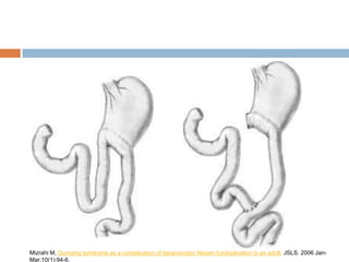 Mizrahi M, Dumping syndrome as a complication of laparoscopic Nissen fundoplication in an adult. JSLS. 2006 Jan-
Mar;10(1):94-6.
 