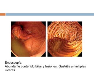 Endoscopía:
Abundante contenido biliar y lesiones. Gastritis a múltiples
 