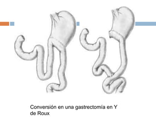 Conversión en una gastrectomía en Y
de Roux
 