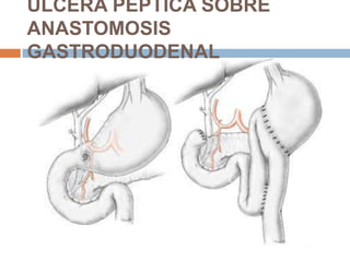 ÚLCERA PÉPTICA SOBRE
ANASTOMOSIS
GASTRODUODENAL
 