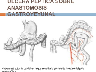 ÚLCERA PÉPTICA SOBRE
ANASTOMOSIS
GASTROYEYUNAL
Nueva gastrectomía parcial en la que se retira la porción de intestino delgado
 