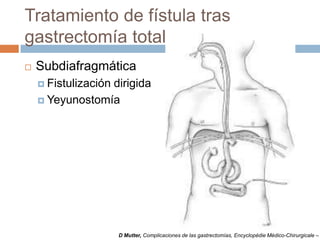 Tratamiento de fístula tras
gastrectomía total
 Subdiafragmática
 Fistulización dirigida
 Yeyunostomía
D Mutter, Complicaciones de las gastrectomías, Encyclopédie Médico-Chirurgicale –
 