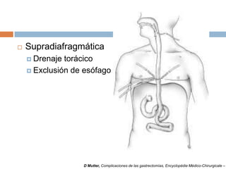  Supradiafragmática
 Drenaje torácico
 Exclusión de esófago
D Mutter, Complicaciones de las gastrectomías, Encyclopédie Médico-Chirurgicale –
 