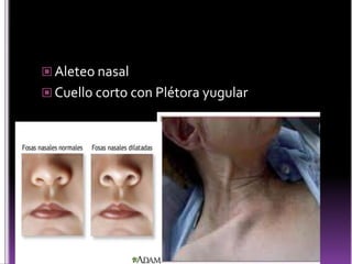  Aleteo nasal
 Cuello corto con Plétora yugular

 