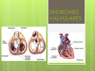 SINDROMES
VALVULARES
 