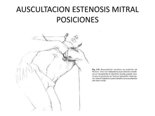 AUSCULTACION ESTENOSIS MITRAL
POSICIONES
 