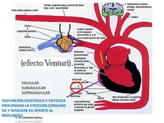 VALVULAR
SUBVALVULAR
SUPRAVALVULAR
DISFUNCION DIASTOLICA Y SISTOLICA
PROLONGAN LA EYECCION,CONSUME
O2 Y DIFICULTA SU APORTE AL
MIOCARDIO
 