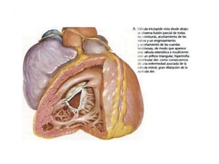 Síndromes Valvulares (Semiología)