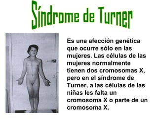 Síndrome de Turner  Es una afección genética que ocurre sólo en las mujeres. Las células de las mujeres normalmente tienen dos cromosomas X, pero en el síndrome de Turner, a las células de las niñas les falta un cromosoma X o parte de un cromosoma X.  