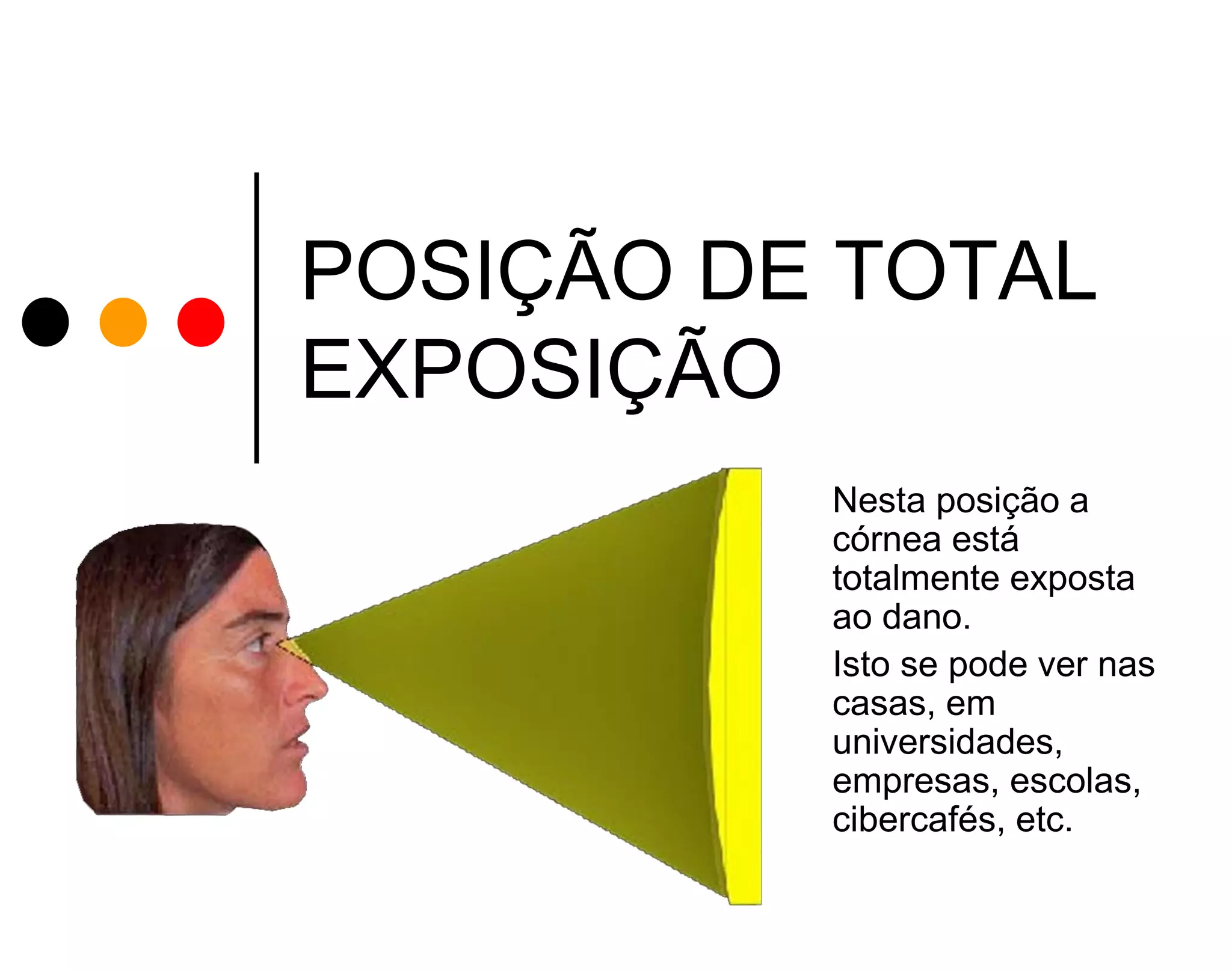 POSIÇÃO DE TOTAL
EXPOSIÇÃO
Nesta posição a
córnea está
totalmente exposta
ao dano.
Isto se pode ver nas
casas, em
universidades,
empresas, escolas,
cibercafés, etc.

 