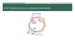 POST STREPTOCOCCAL GLOMERULONEPHRITIS
 