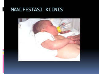 MANIFESTASI KLINIS
 