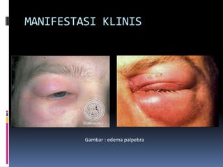 MANIFESTASI KLINIS
Gambar : edema palpebra
 