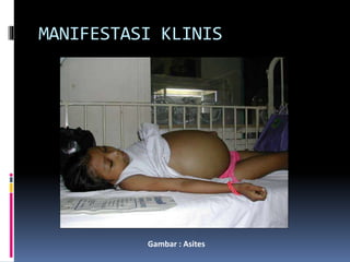 MANIFESTASI KLINIS
Gambar : Asites
 