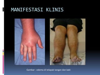 MANIFESTASI KLINIS
Gambar : edema di telapak tangan dan kaki
 
