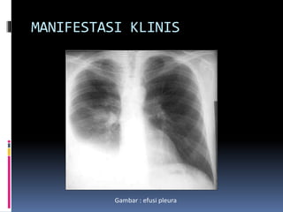 MANIFESTASI KLINIS
Gambar : efusi pleura
 