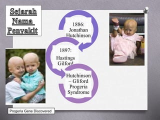 1886:
Jonathan
Hutchinson
1897:
Hastings
Gilford
Hutchinson
– Gliford
Progeria
Syndrome
Progeria Gene Discovered
 