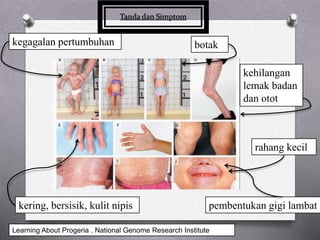 kegagalan pertumbuhan botak
rahang kecil
kering, bersisik, kulit nipis pembentukan gigi lambat
kehilangan
lemak badan
dan otot
Learning About Progeria . National Genome Research Institute
 