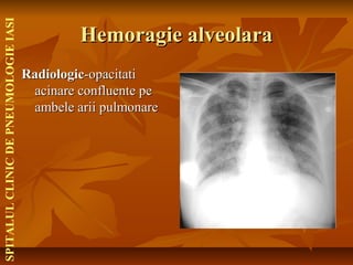 Sindromul de umplere alveolara | PPT