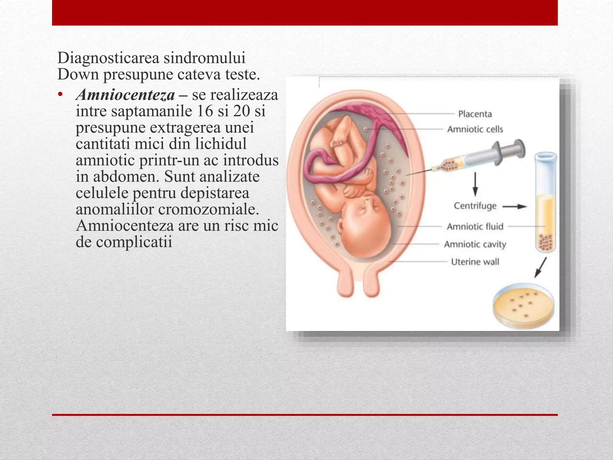 Diagnosticarea sindromului
Down presupune cateva teste.
• Amniocenteza – se realizeaza
intre saptamanile 16 si 20 si
presupune extragerea unei
cantitati mici din lichidul
amniotic printr-un ac introdus
in abdomen. Sunt analizate
celulele pentru depistarea
anomaliilor cromozomiale.
Amniocenteza are un risc mic
de complicatii
 