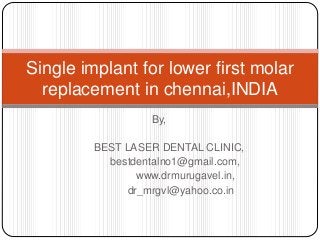 By,
BEST LASER DENTAL CLINIC,
bestdentalno1@gmail.com,
www.drmurugavel.in,
dr_mrgvl@yahoo.co.in
Single implant for lower first molar
replacement in chennai,INDIA
 