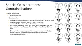 Special Considerations:
Contraindications
• Sacral deformities
• Unclear landmarks
• Sacral dimple
• May overlie spinal dysraphism, spina bifida occulta or tethered cord
• If MR imaging is available, it may rule out anomalies
• Ultrasound evaluation of the sacrum in skilled hands will also rule
out anomalies and allow visualization of the thecal sac and spinal
cord.
• Sacral dimples are common and themselves are not an indication
for MR scanning unless unusually deep or associated with
neurologic abnormalities
 