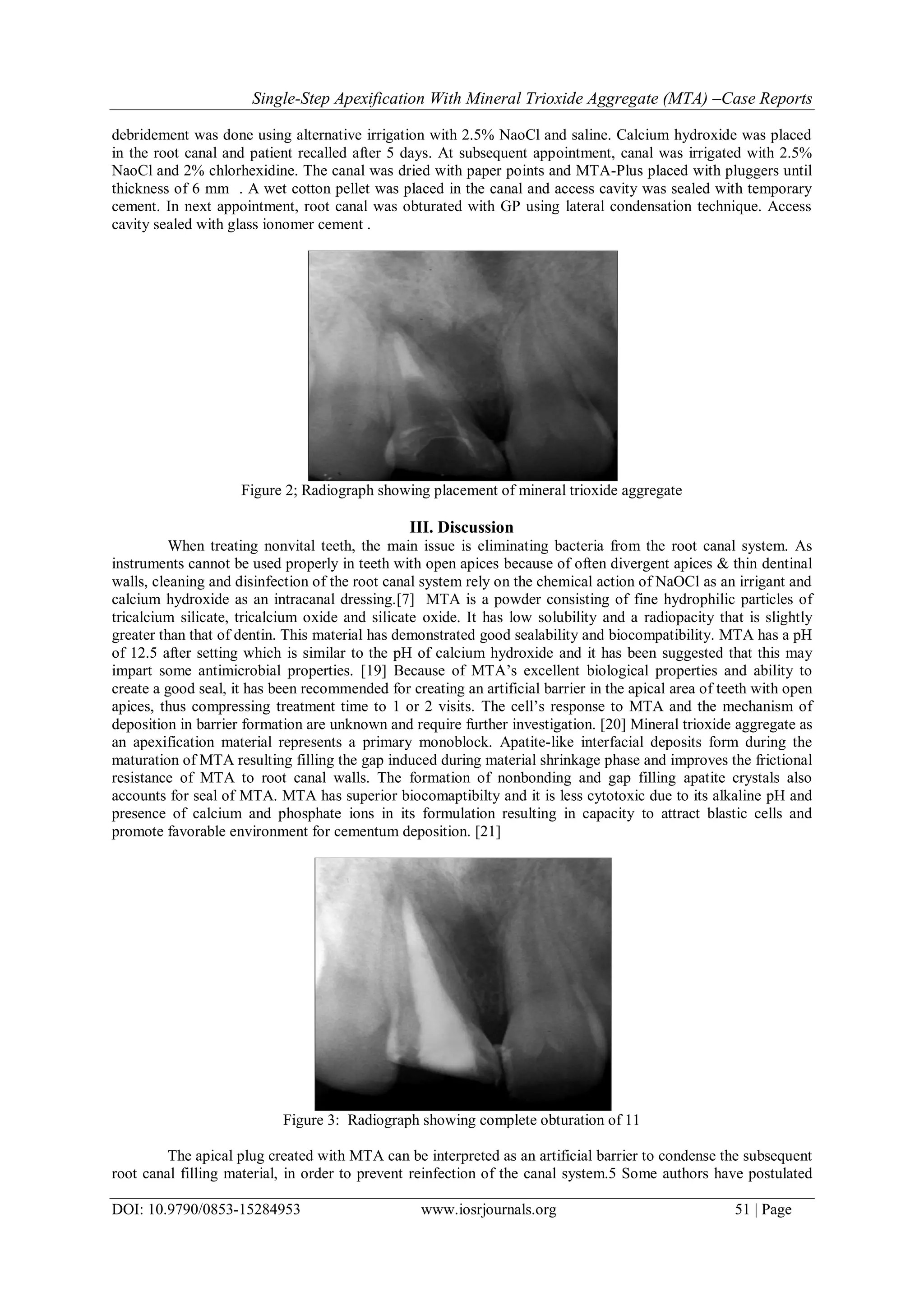 Single-Step Apexification With Mineral Trioxide Aggregate (MTA) –Case Reports
DOI: 10.9790/0853-15284953 www.iosrjournals.org 51 | Page
debridement was done using alternative irrigation with 2.5% NaoCl and saline. Calcium hydroxide was placed
in the root canal and patient recalled after 5 days. At subsequent appointment, canal was irrigated with 2.5%
NaoCl and 2% chlorhexidine. The canal was dried with paper points and MTA-Plus placed with pluggers until
thickness of 6 mm . A wet cotton pellet was placed in the canal and access cavity was sealed with temporary
cement. In next appointment, root canal was obturated with GP using lateral condensation technique. Access
cavity sealed with glass ionomer cement .
Figure 2; Radiograph showing placement of mineral trioxide aggregate
III. Discussion
When treating nonvital teeth, the main issue is eliminating bacteria from the root canal system. As
instruments cannot be used properly in teeth with open apices because of often divergent apices & thin dentinal
walls, cleaning and disinfection of the root canal system rely on the chemical action of NaOCl as an irrigant and
calcium hydroxide as an intracanal dressing.[7] MTA is a powder consisting of fine hydrophilic particles of
tricalcium silicate, tricalcium oxide and silicate oxide. It has low solubility and a radiopacity that is slightly
greater than that of dentin. This material has demonstrated good sealability and biocompatibility. MTA has a pH
of 12.5 after setting which is similar to the pH of calcium hydroxide and it has been suggested that this may
impart some antimicrobial properties. [19] Because of MTA’s excellent biological properties and ability to
create a good seal, it has been recommended for creating an artificial barrier in the apical area of teeth with open
apices, thus compressing treatment time to 1 or 2 visits. The cell’s response to MTA and the mechanism of
deposition in barrier formation are unknown and require further investigation. [20] Mineral trioxide aggregate as
an apexification material represents a primary monoblock. Apatite-like interfacial deposits form during the
maturation of MTA resulting filling the gap induced during material shrinkage phase and improves the frictional
resistance of MTA to root canal walls. The formation of nonbonding and gap filling apatite crystals also
accounts for seal of MTA. MTA has superior biocomaptibilty and it is less cytotoxic due to its alkaline pH and
presence of calcium and phosphate ions in its formulation resulting in capacity to attract blastic cells and
promote favorable environment for cementum deposition. [21]
Figure 3: Radiograph showing complete obturation of 11
The apical plug created with MTA can be interpreted as an artificial barrier to condense the subsequent
root canal filling material, in order to prevent reinfection of the canal system.5 Some authors have postulated
 