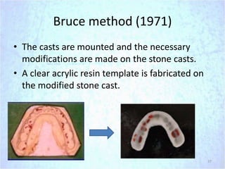 Single complete denture | PPTX