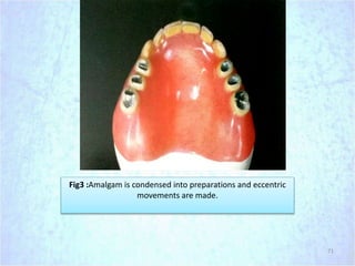 71
Fig3 :Amalgam is condensed into preparations and eccentric
movements are made.
 