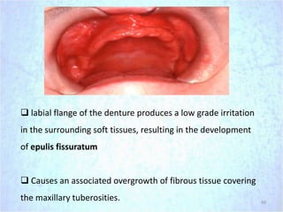 80
 labial flange of the denture produces a low grade irritation
in the surrounding soft tissues, resulting in the development
of epulis fissuratum
 Causes an associated overgrowth of fibrous tissue covering
the maxillary tuberosities.
 