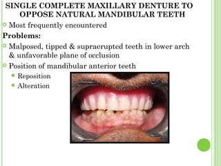 SINGLE COMPLETE MAXILLARY DENTURE TO
OPPOSE NATURAL MANDIBULAR TEETH
 Most frequently encountered
Problems:
 Malposed, t...
