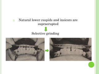 2. Natural lower cuspids and insicors are
supraerupted
Selective grinding
 