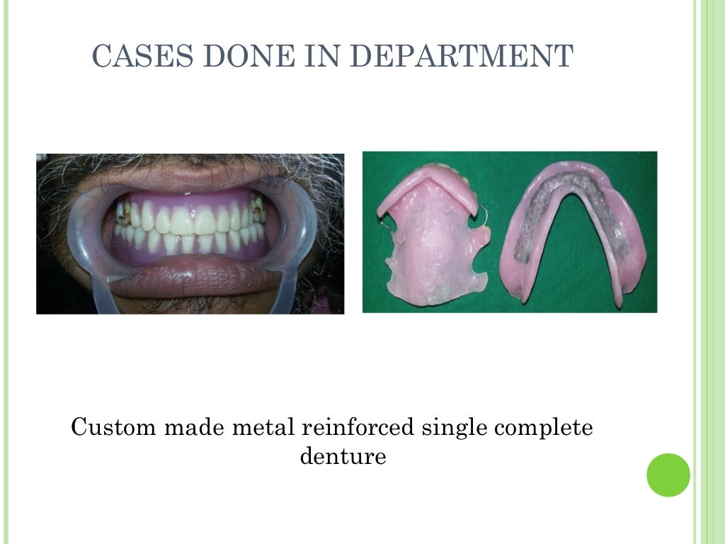 Single Complete Denture