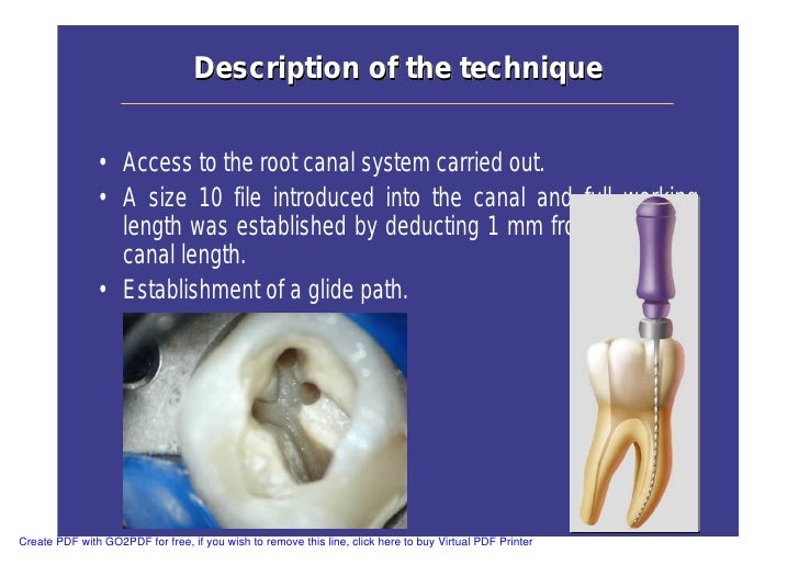 Single Cone Obturation Technique Ppt
