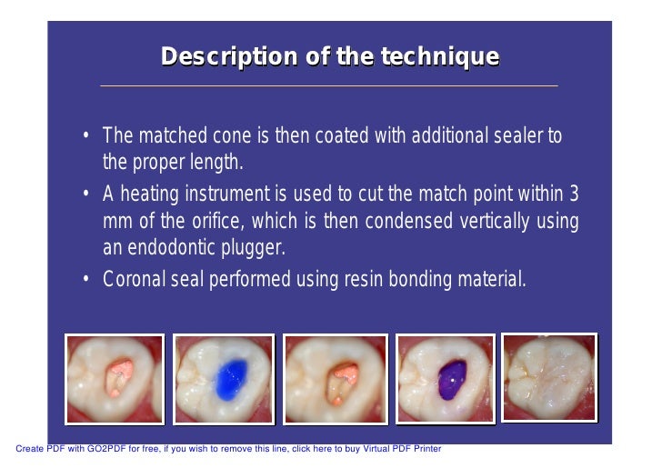 Single Cone Obturation Technique Ppt