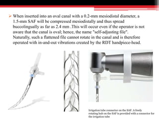 When inserted into an oval canal with a 0.2-mm mesiodistal diameter, a
1.5-mm SAF will be compressed mesiodistally and thus spread
buccolingually as far as 2.4 mm .This will occur even if the operator is not
aware that the canal is oval; hence, the name "self-adjusting file".
Naturally, such a flattened file cannot rotate in the canal and is therefore
operated with in-and-out vibrations created by the RDT handpiece-head.
Irrigation tube connector on the SAF. A freely
rotating hub on the SAF is provided with a connector for
the irrigation tube
 