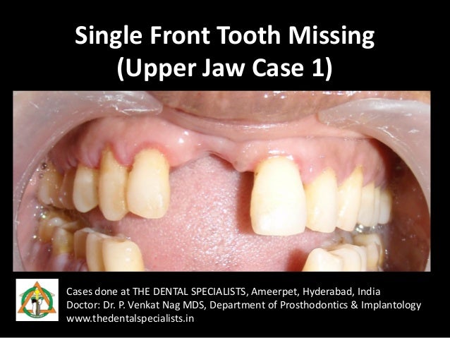 Best option for front tooth replacement