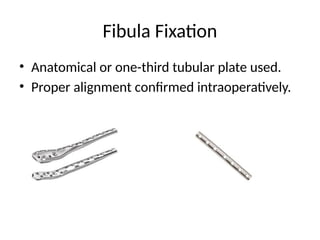 Single-Incision Internal Fixation Technique for Distal Tibia and Fibula ...
