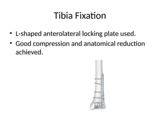 Single-Incision Internal Fixation Technique for Distal Tibia and Fibula ...